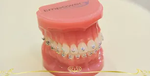 セラミック矯正