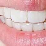 歯並びのイメージ